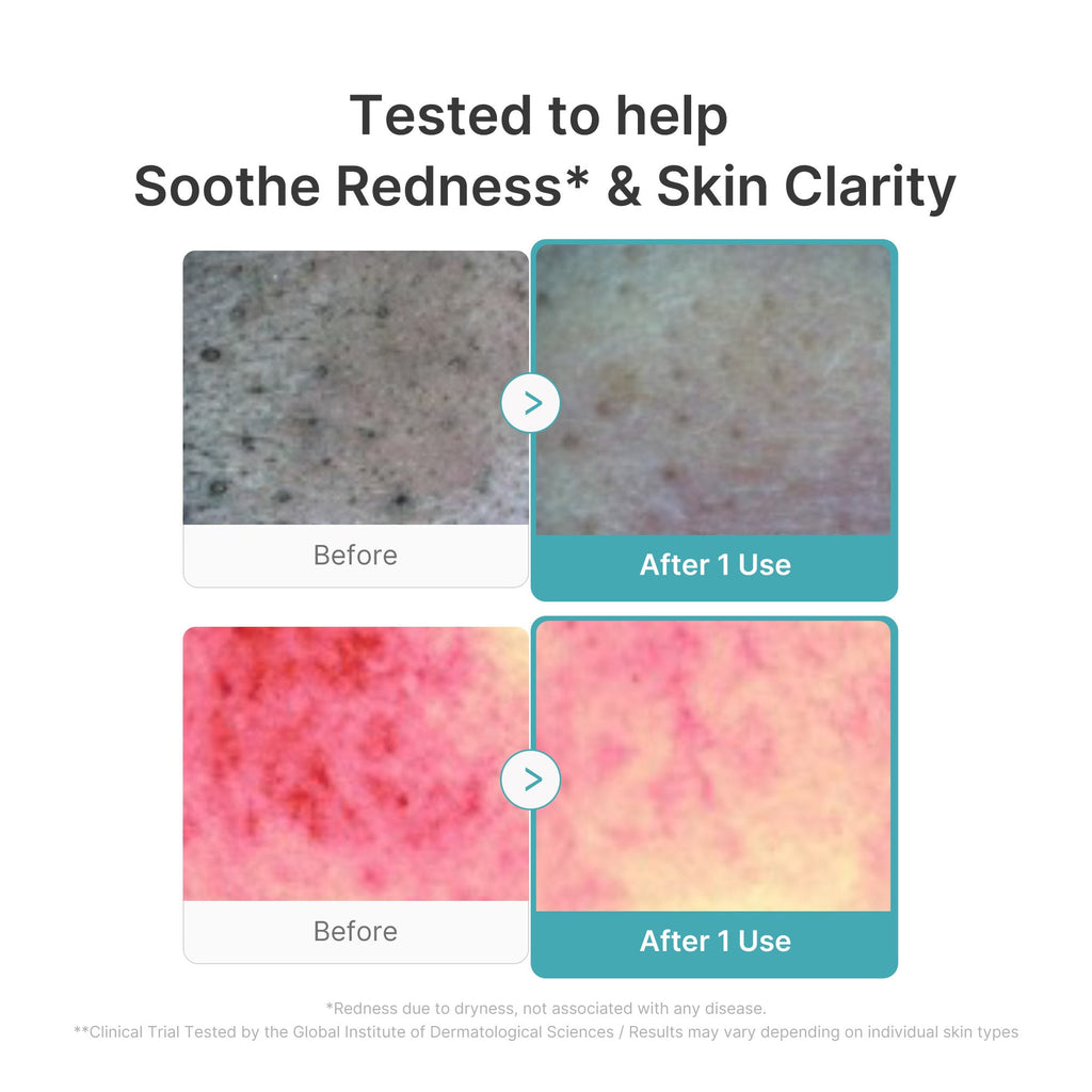 Azelaic Acid Capsule Foam Cleanser N5